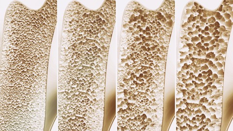 Natural Osteoporosis and Menopause
