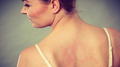 Learn About Eczema