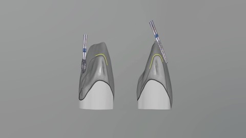數位牙科必勝法則系列-2：從 Macro 到 Micro 改善你的 CAD/CAM Preparation！