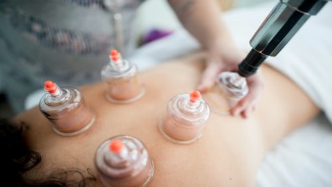 Modern Cupping Therapy