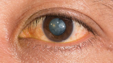 Homeopathic approach for Cataract